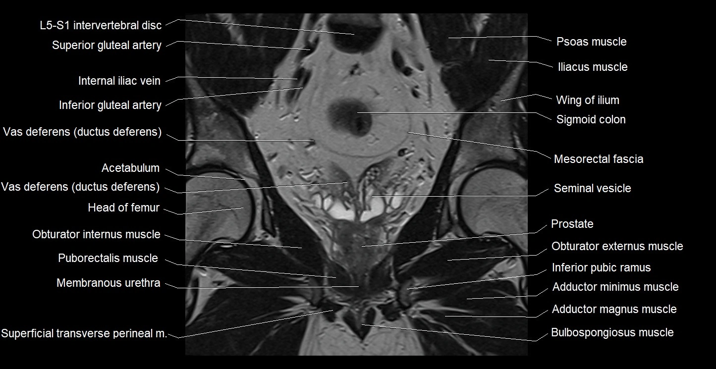 MRI coronal cross sectional anatomy male pelvis image 21.webp